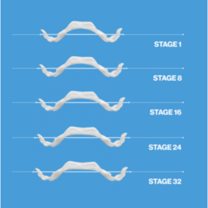 palatal expander etapas