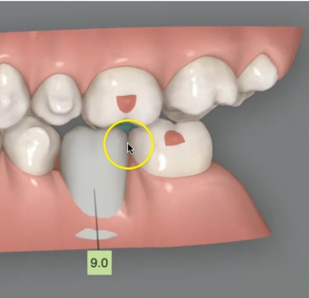 What to do if you have “extra” aligners when planning a treatment