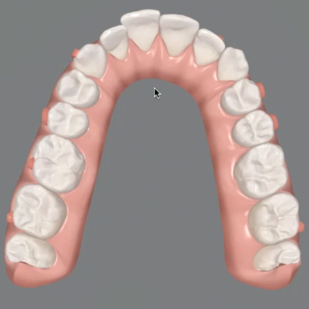 Arch expansion with limited clear aligner packages