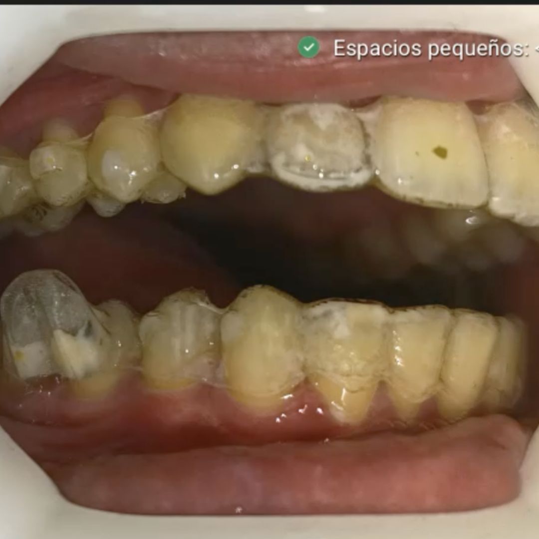 Mandibular advancement with clear aligners
