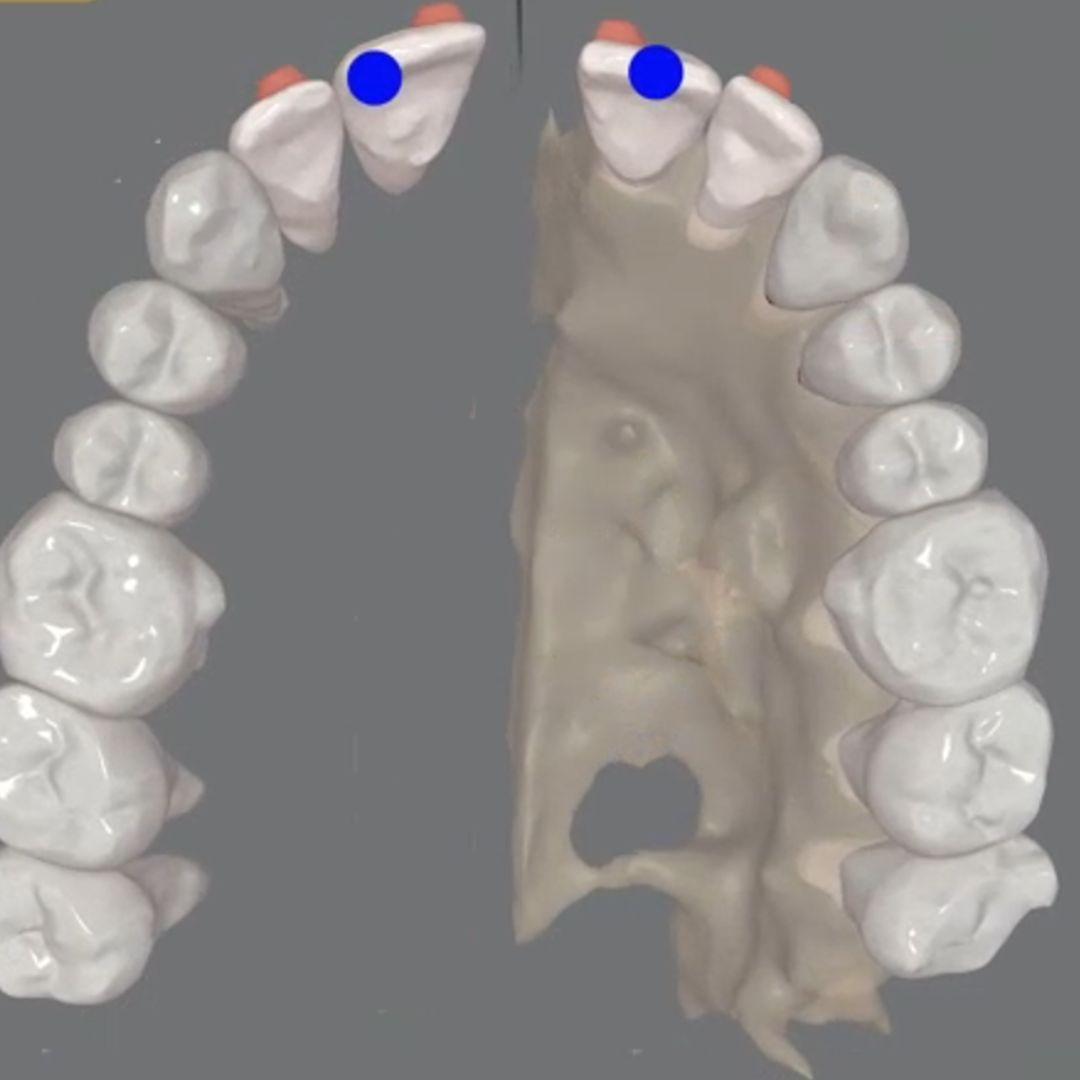 How to close the interincisal diastema after MARPE