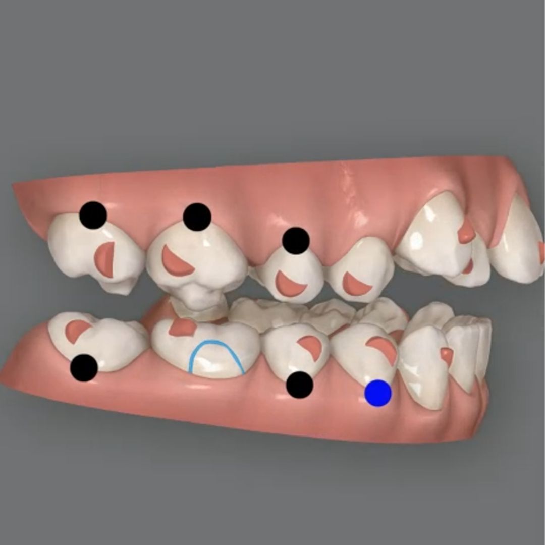 How to intrude molars with clear aligners