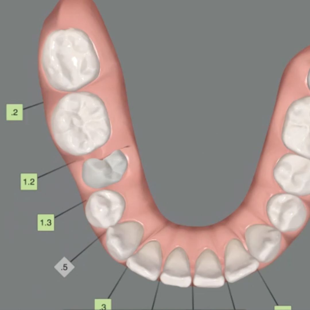 Impacted tooth traction with aligners | sequencing and biomechanics