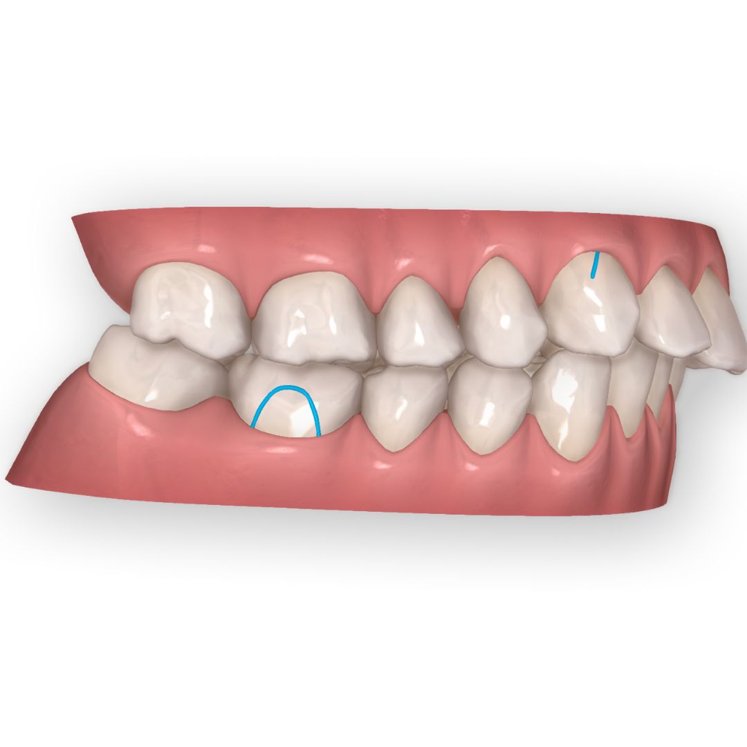 The virtual mesial jump with clear aligners: a predictable approach