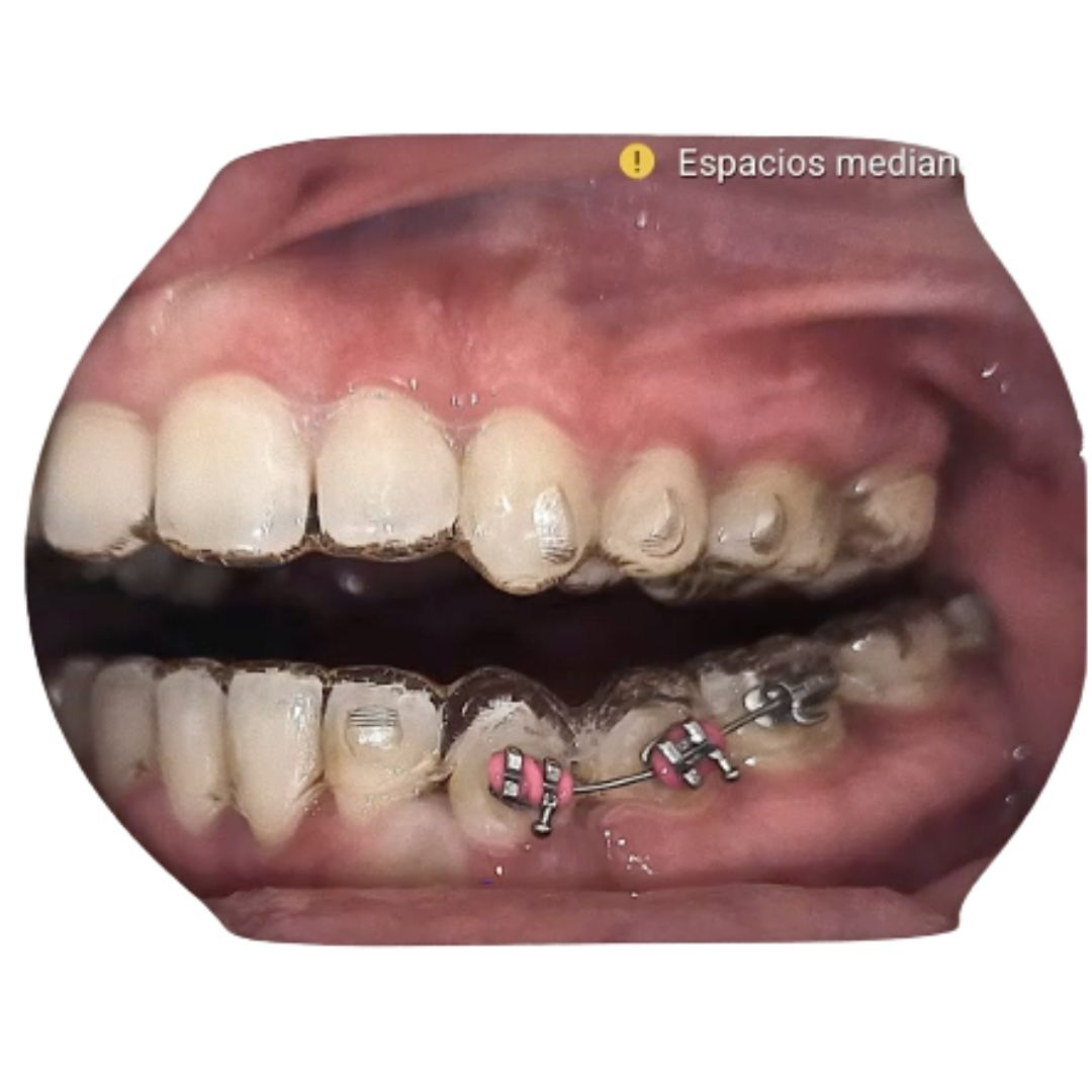 Integrating sectional arches into clear aligner treatment