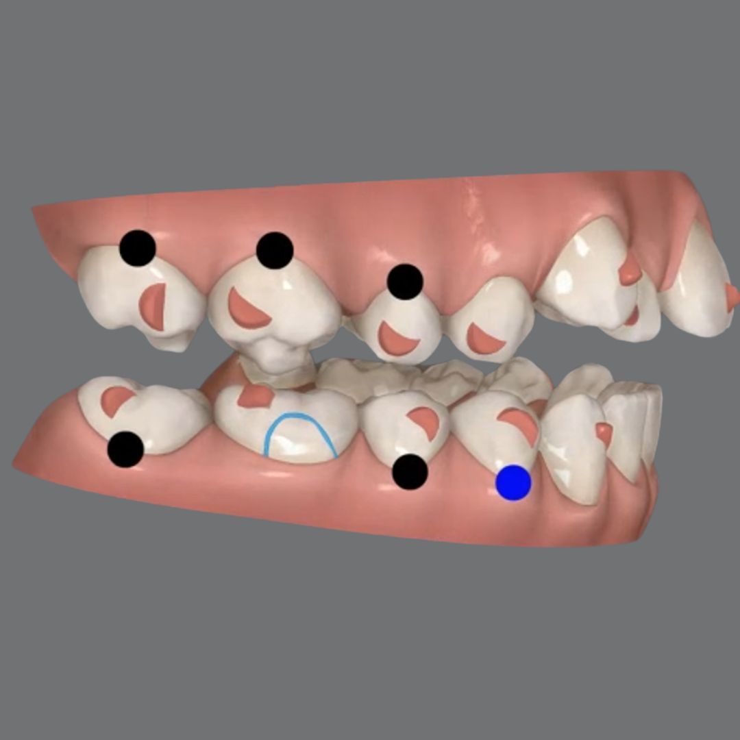 Molar uprighting in a single aligner package