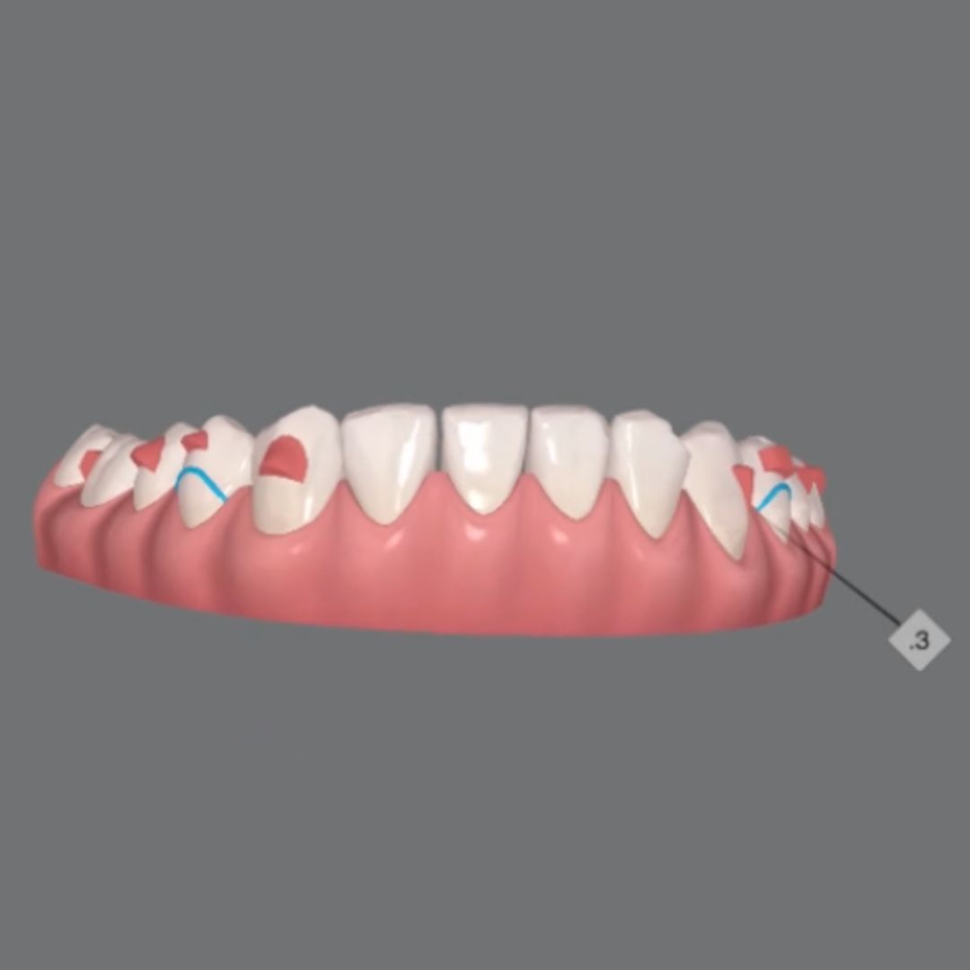 Flattening the Spee curve with a limited number of aligners
