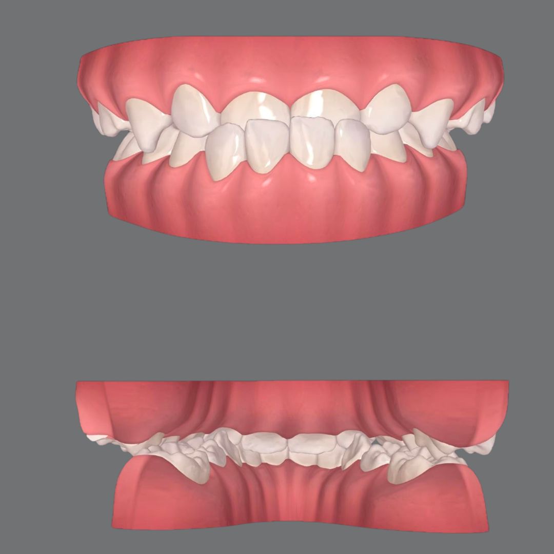 Arch Compression with Aligners: Why Sequence Beats Force