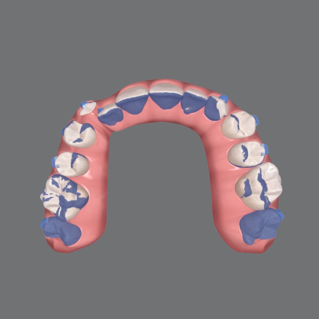 Third molar anchorage for arch development, step by step