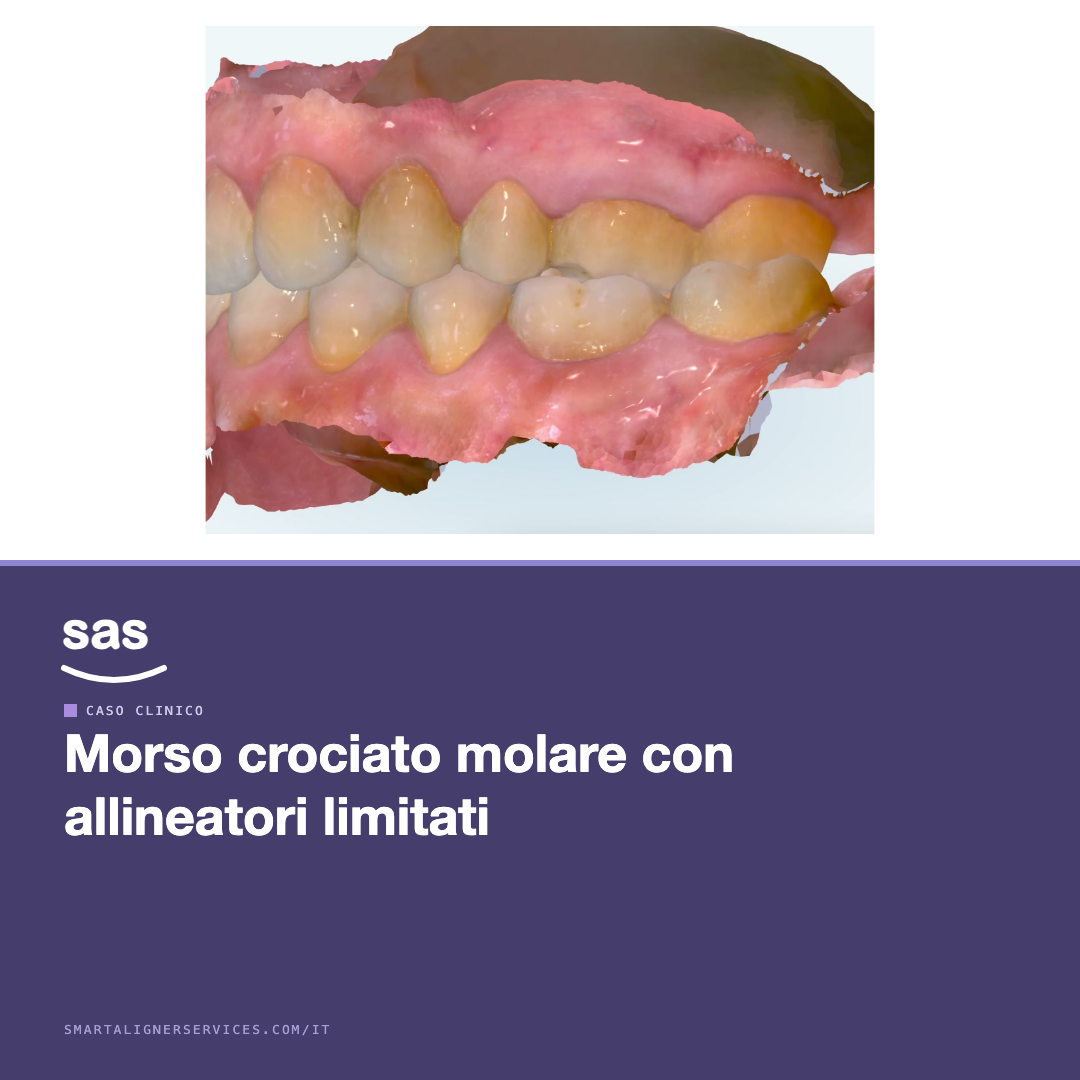 Come risolvere un morso crociato molare con allineatori limitati