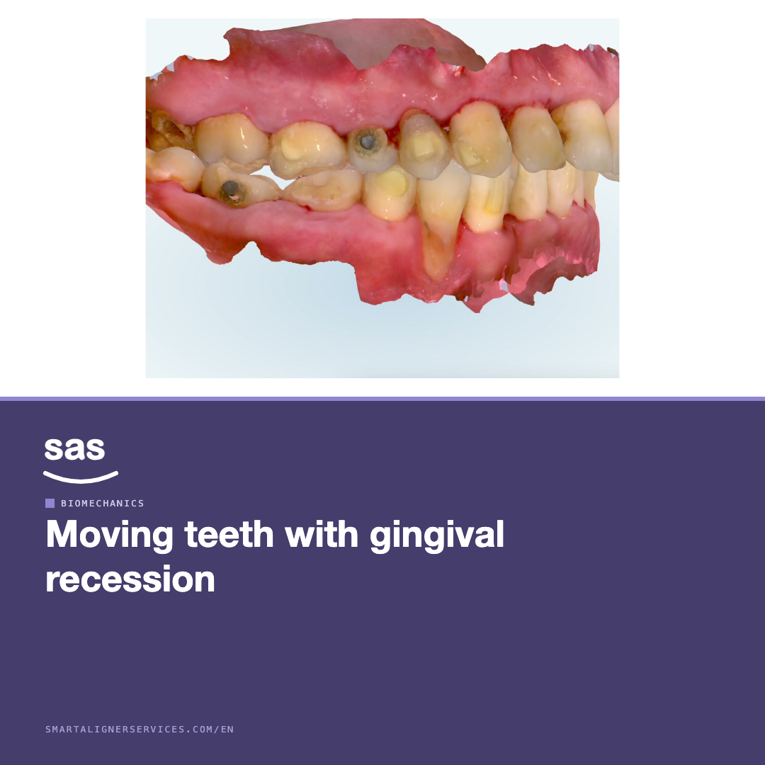 Moving teeth with gingival recession: sequence before force
