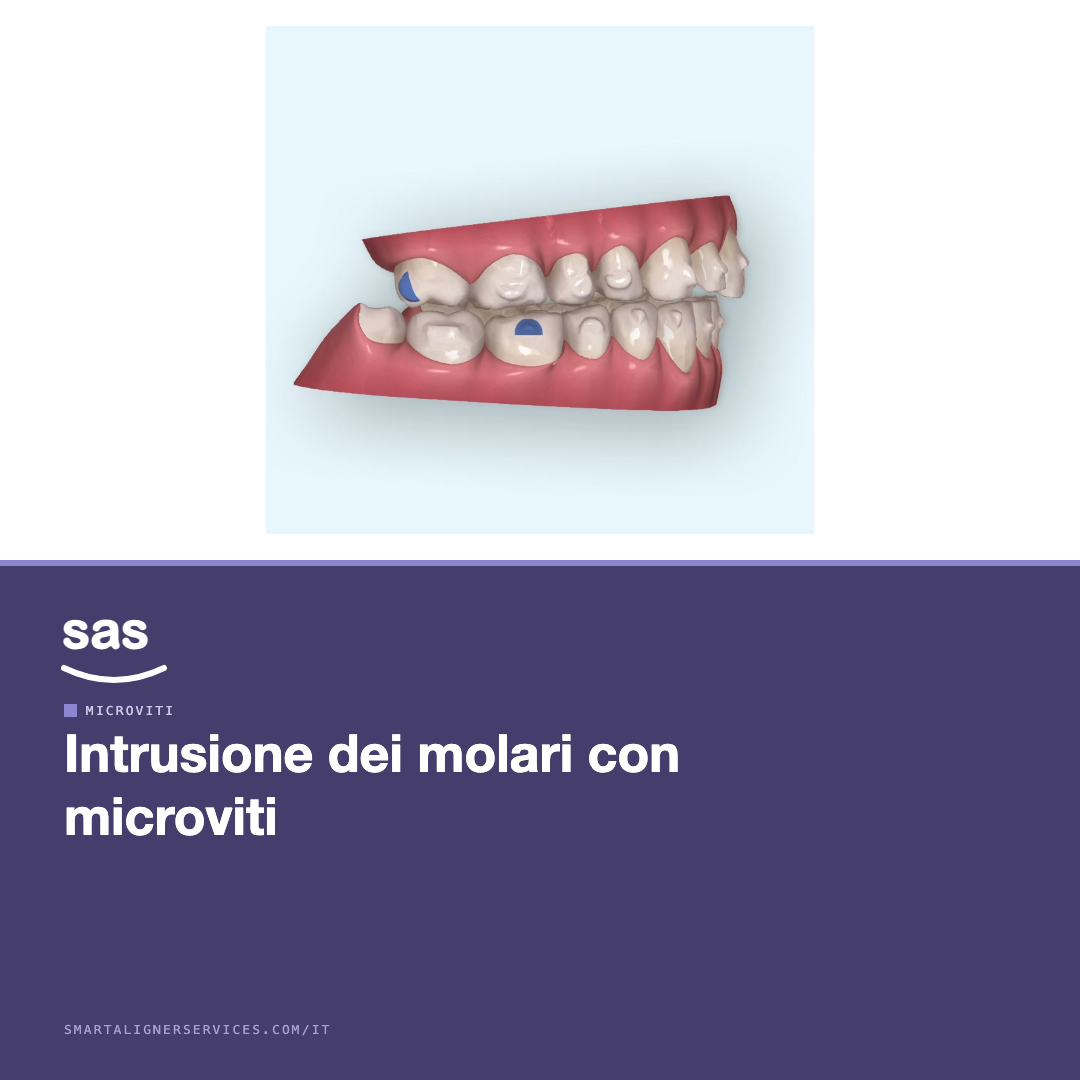 Intrusione dei molari con microviti per chiudere un morso aperto