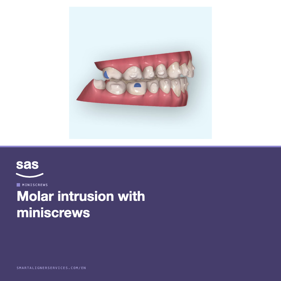 Molar intrusion with miniscrews to close an open bite