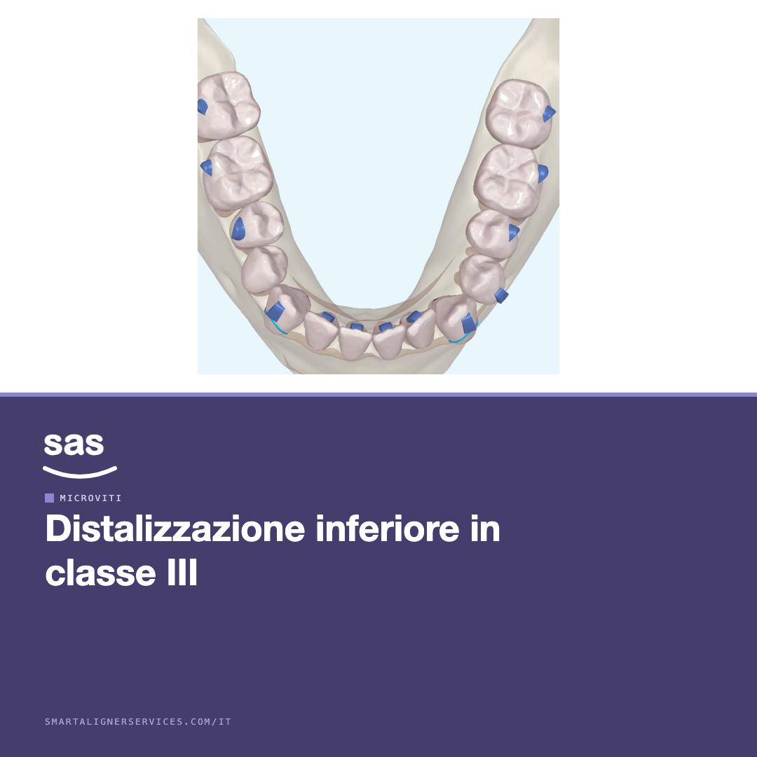 Distalizzazione inferiore con microviti nella classe III