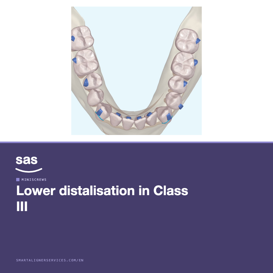 Lower distalisation with miniscrews in Class III