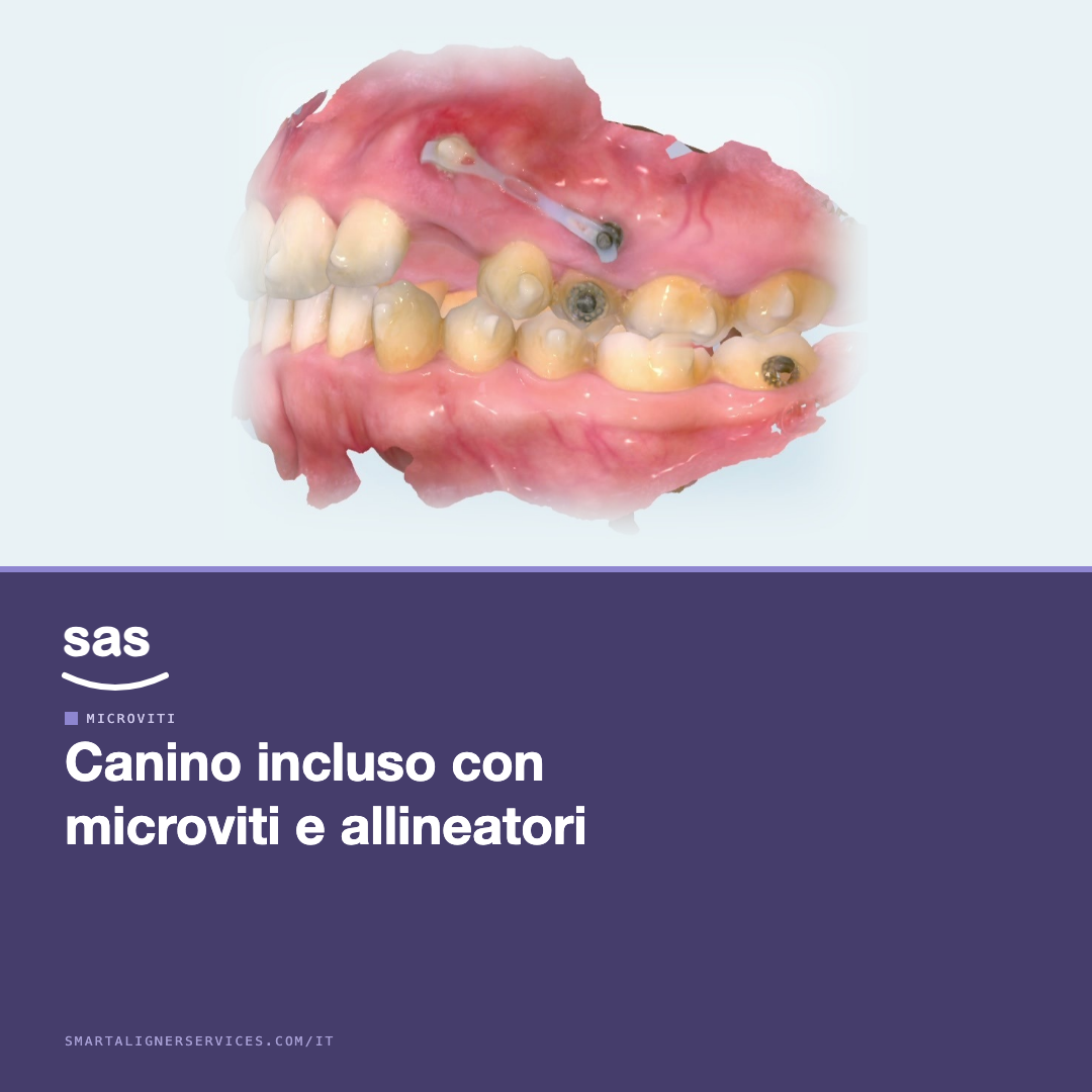 Trazionare un canino incluso con microviti e allineatori