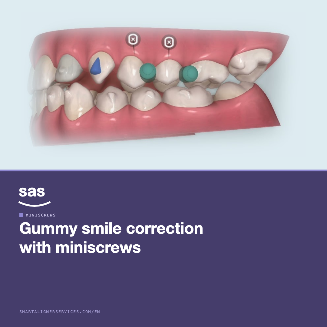 Correcting a gummy smile with miniscrews and clear aligners