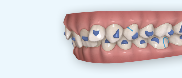 Negative torque on upper incisors