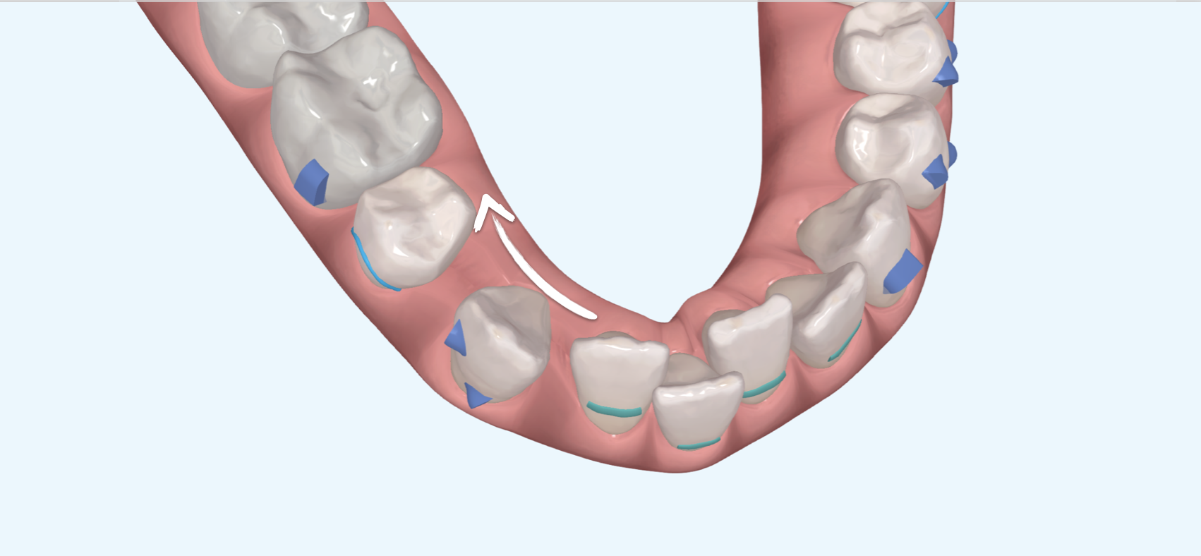 Extractions with aligners
