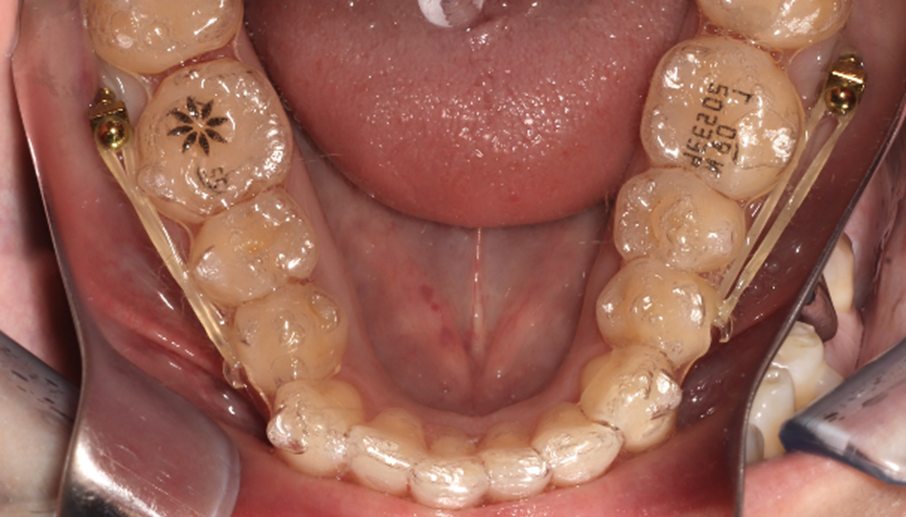 Elásticos a microtornillos buccal shelf 3/16" 4 oZ