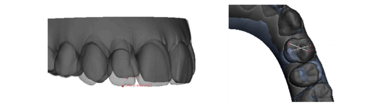 ATTACHMENTS In Clear Aligner